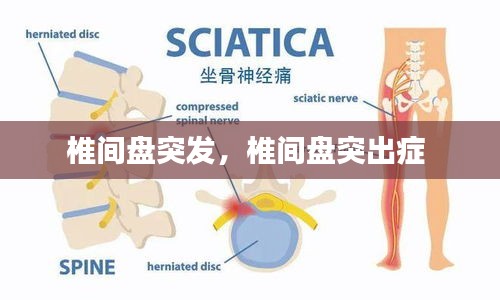 椎间盘突发，椎间盘突出症 